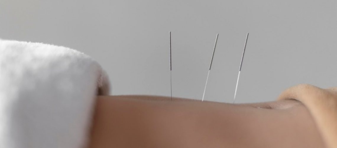 close-up-acupuncture-procedure_23-2148815310
